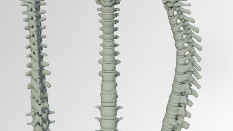 Mechanical Disorders of the Spine