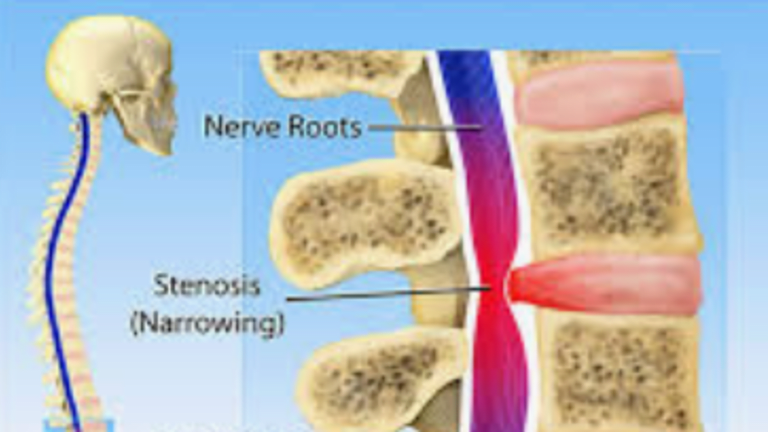 Lower Back Pain? Is It Hip Arthritis or Lumbar Spinal Stenosis?
