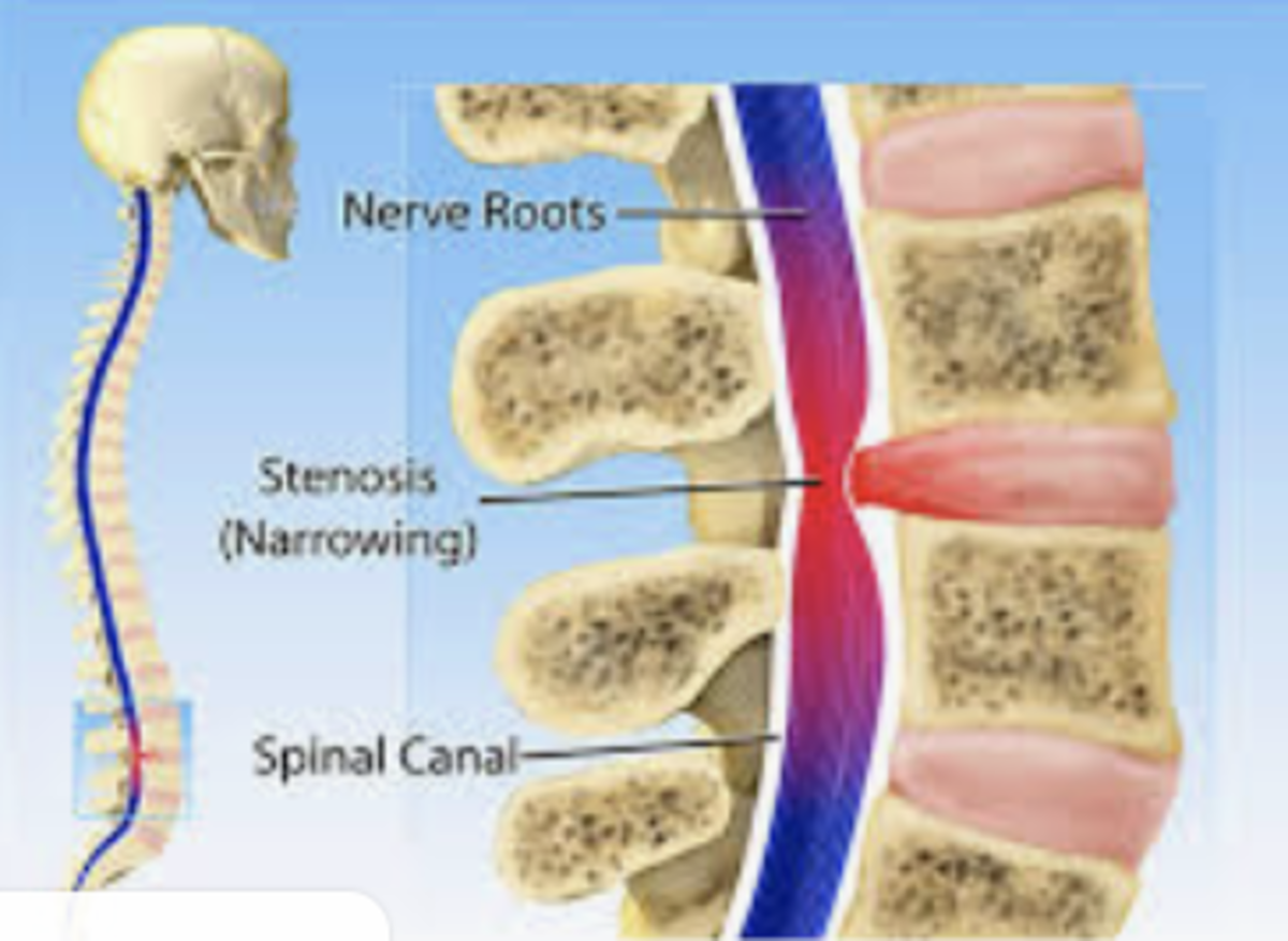 What Is Arthritis In The Lower Back